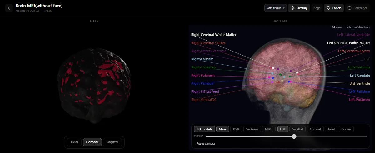 Brain MRI in the DecodeMed radiology atlas with the cortex, white matter, ventricles, caudate, putamen, pallidum and thalamus labelled on the 3D volume
