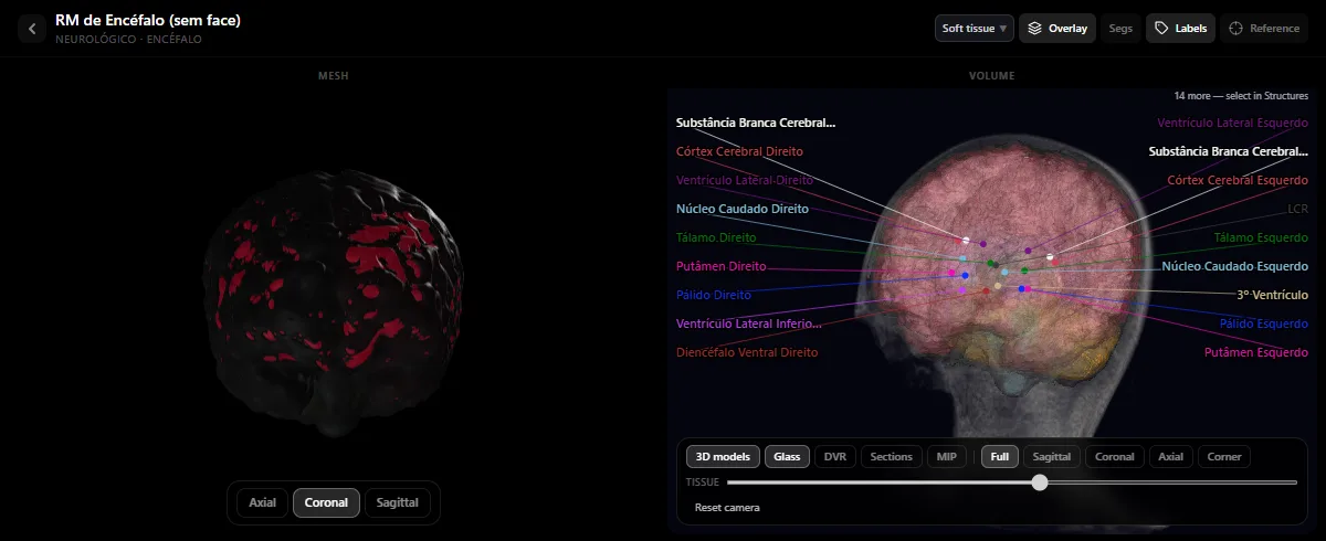 RM de crânio no atlas de radiologia do DecodeMed com o córtex, a substância branca, os ventrículos, o caudado, o putâmen, o globo pálido e o tálamo legendados no volume 3D