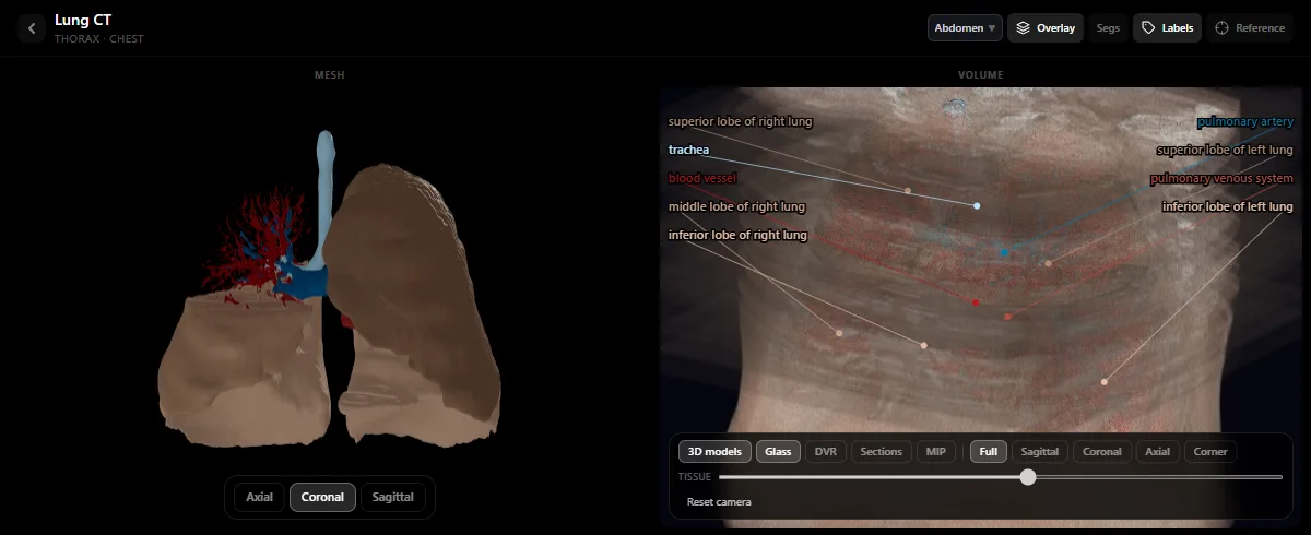 Lung CT in the DecodeMed radiology atlas: 3D models of the lungs, trachea and pulmonary vessels, with the five lobes labelled on the CT volume