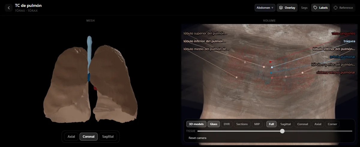 TC de pulmón en el atlas de radiología de DecodeMed: modelos 3D de los pulmones, la tráquea y los vasos pulmonares, con los cinco lóbulos rotulados sobre el volumen de la TC