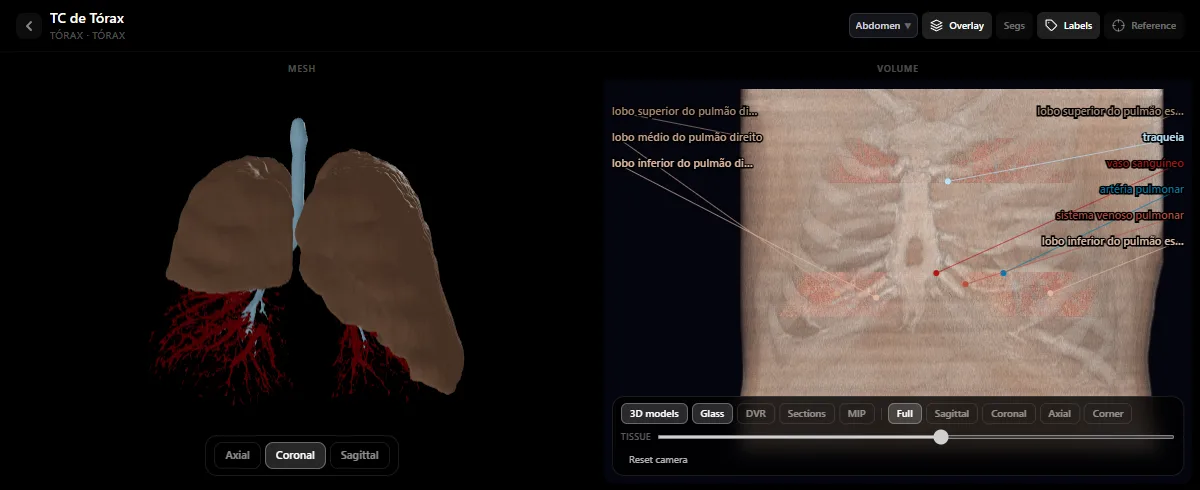 TC de pulmão no atlas de radiologia do DecodeMed: modelos 3D dos pulmões, da traqueia e dos vasos pulmonares, com os cinco lobos legendados no volume da TC