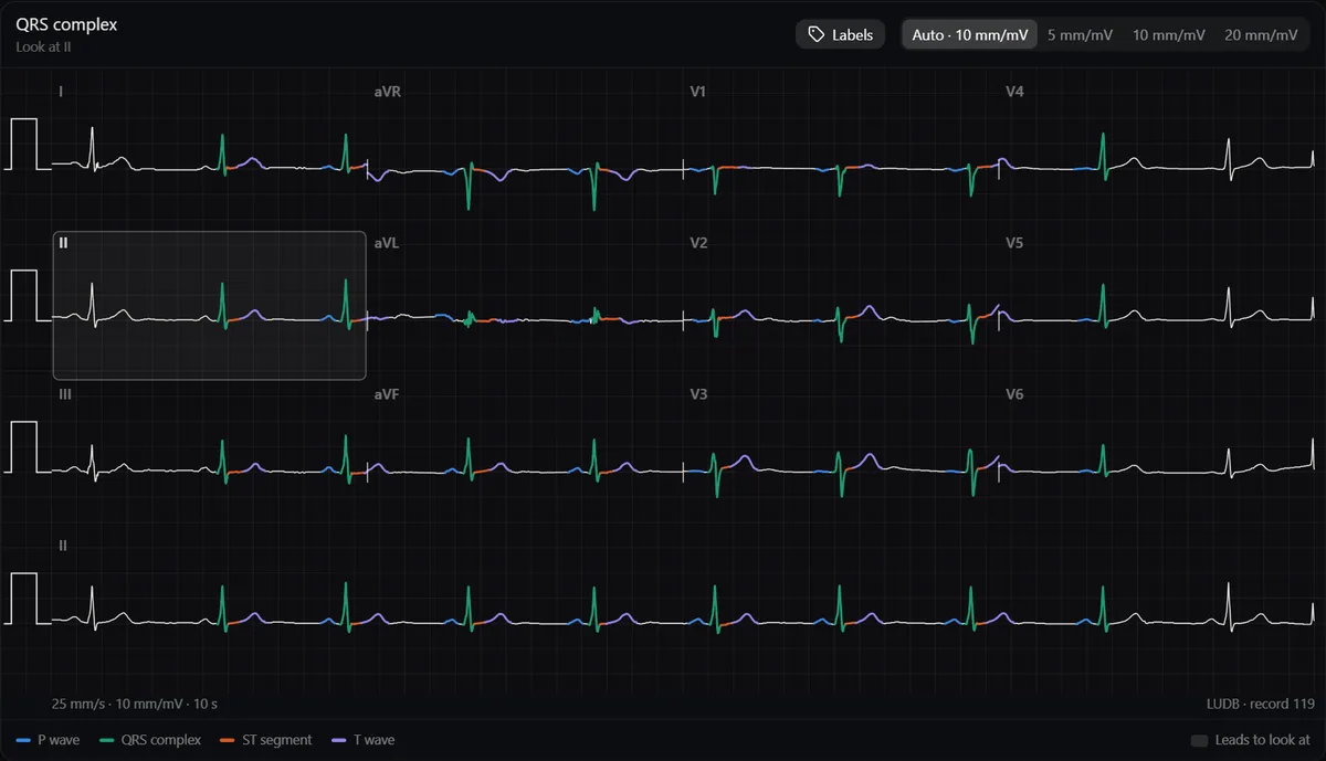 Normal 12-lead ECG in the DecodeMed ECG atlas, with the P waves, QRS complexes, ST segments and T waves coloured in every lead and a lead II rhythm strip