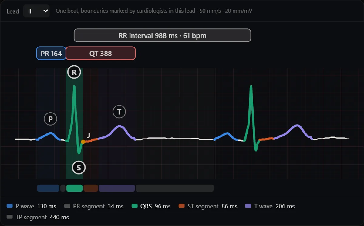 One heartbeat in lead II labelled P, R, S, J and T, with the RR interval of 988 ms, a PR of 164 ms and a QT of 388 ms, and the duration of each wave and segment below