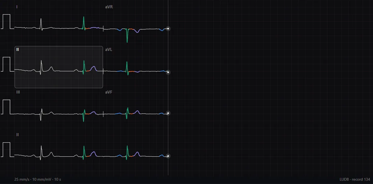 A 12-lead ECG being drawn in real time at 25 mm/s in the DecodeMed ECG atlas, with the sweep line halfway across the paper