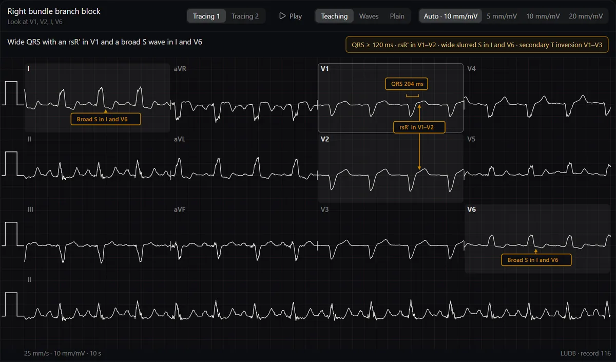 Right bundle branch block in the DecodeMed ECG atlas: callouts point to the rsR′ in V1–V2 and the broad S wave in I and V6, with the diagnostic criteria in a box