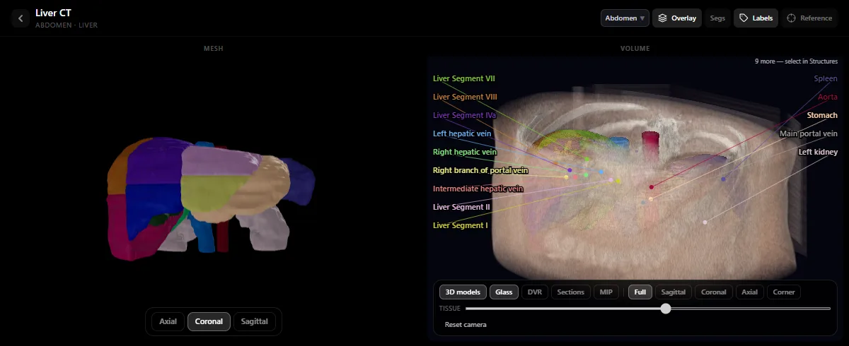Liver CT in the DecodeMed radiology atlas: the Couinaud segments as colour-coded 3D models, with the hepatic veins and the portal vein labelled
