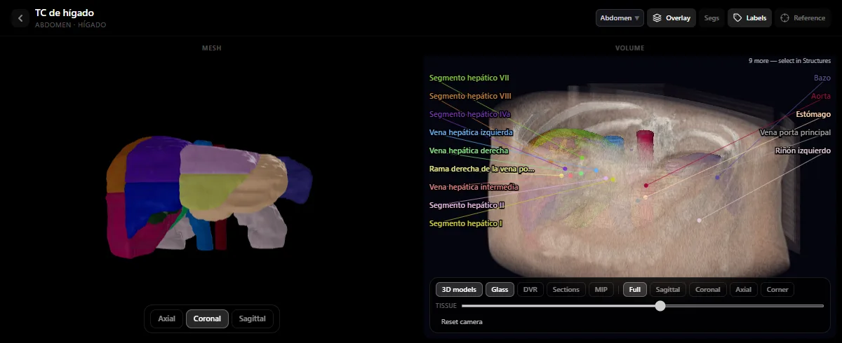 TC de hígado en el atlas de radiología de DecodeMed: los segmentos de Couinaud como modelos 3D de colores, con las venas suprahepáticas y la vena porta rotuladas