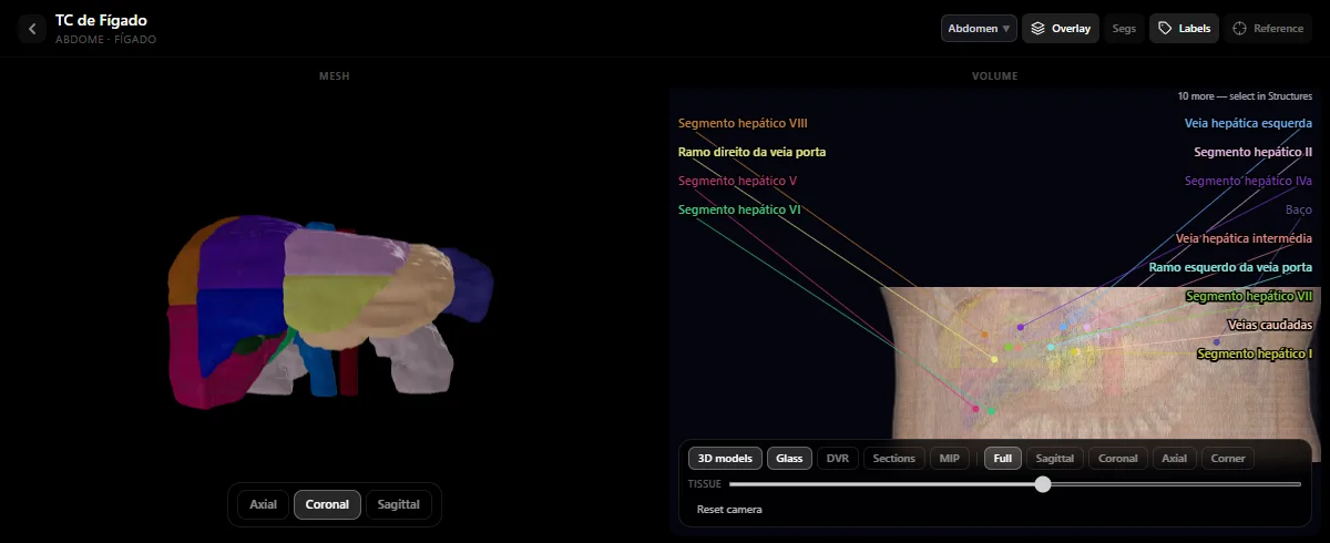TC de fígado no atlas de radiologia do DecodeMed: os segmentos de Couinaud como modelos 3D coloridos, com as veias hepáticas e a veia porta legendadas