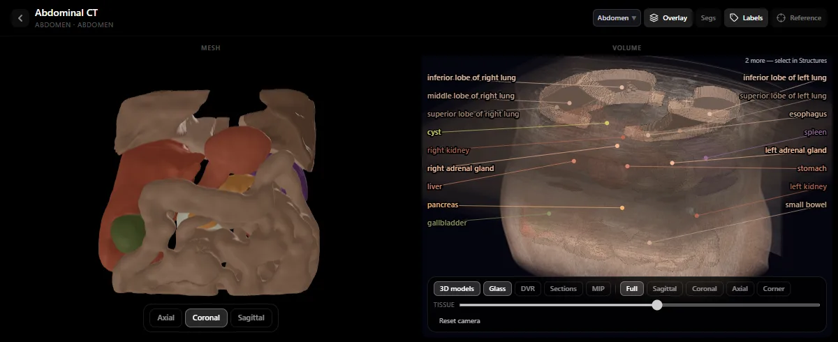 Abdominal CT in the RadioAnatomy radiology atlas: 3D models of the organs beside the CT volume, with liver, kidneys, spleen, pancreas, stomach and adrenal glands labelled