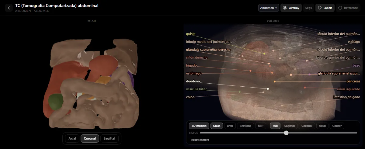 TC abdominal en el atlas de radiología de RadioAnatomy: modelos 3D de los órganos junto al volumen de la TC, con hígado, riñones, bazo, páncreas, estómago y glándulas suprarrenales rotulados