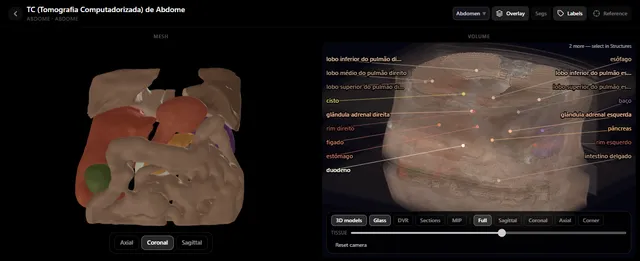 TC de abdome no atlas de radiologia do RadioAnatomy: modelos 3D dos órgãos ao lado do volume da TC, com fígado, rins, baço, pâncreas, estômago e glândulas suprarrenais legendados