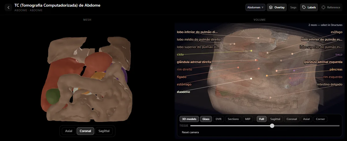 TC de abdome no atlas de radiologia do RadioAnatomy: modelos 3D dos órgãos ao lado do volume da TC, com fígado, rins, baço, pâncreas, estômago e glândulas suprarrenais legendados